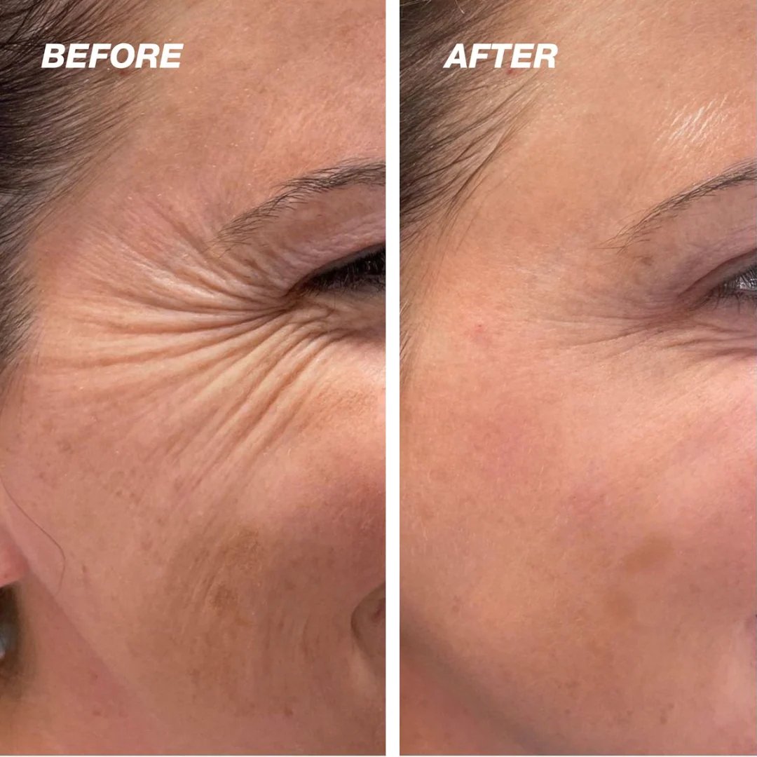 （🔥Kupite 1 dobite 1 gratis🔥)Vroča razprodaja 41 % POPUSTA - HOOMWELL™ Vita A Retinal Shot za učvrstitev mrežnice